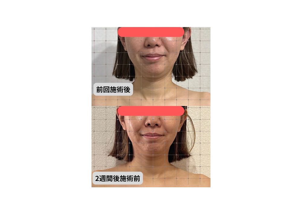 小顔矯正