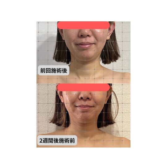 小顔矯正